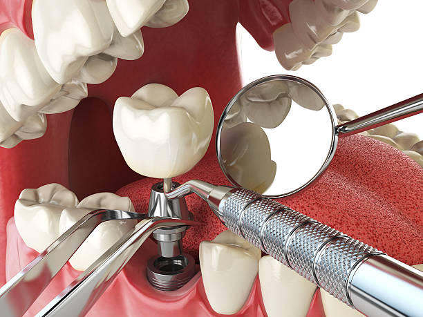 Best Emergency Treatment for Dental Infections or Abscesses in Violet, LA